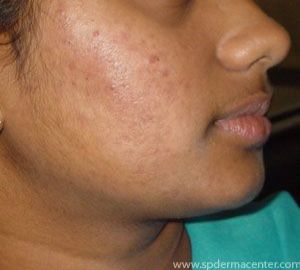 Acne-After
